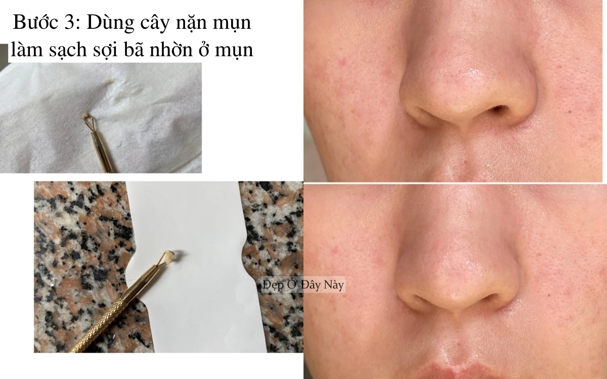 Ở tuổi 27, tôi học được cách làm sạch mụn đầu đen ở mũi hiệu quả, làm 1 lần là "nhẵn thín"- Ảnh 4.