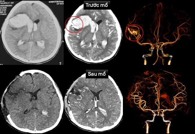 TP.HCM: Bé gái 13 tuổi đột quỵ, xuất huyết não, sốc tim khi đang ngủ- Ảnh 1. TP.HCM: Bé gái 13 tuổi đột quỵ, xuất huyết não, sốc tim khi đang ngủ- Ảnh 1.