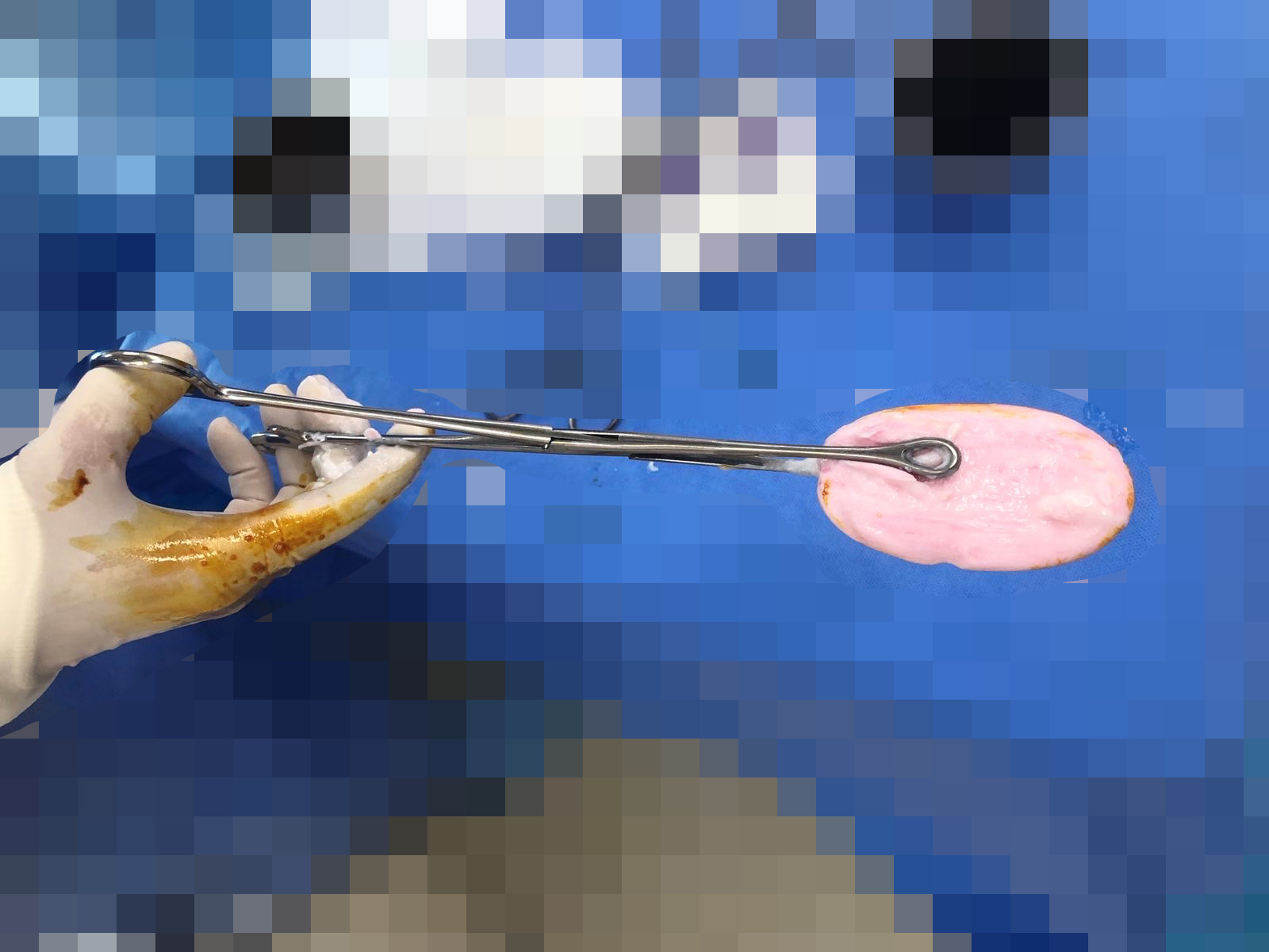 Bé gái 12 tuổi ở TP.HCM phải đi cấp cứu vì nhét xà phòng vào vùng kín lúc đang tắm- Ảnh 1. Bé gái 12 tuổi ở TP.HCM phải đi cấp cứu vì nhét xà phòng vào vùng kín lúc đang tắm- Ảnh 1.