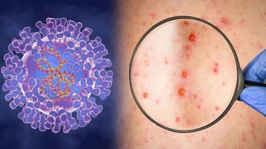 Xuất hiện ca bệnh đậu mùa khỉ chưa rõ nguồn lây ở Đồng Nai- Ảnh 1.