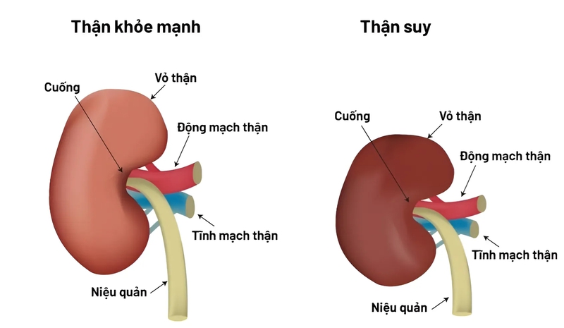 Nữ nghệ sĩ múa bị suy thận sau khi sinh con, chồng hiến thận cứu vợ: 