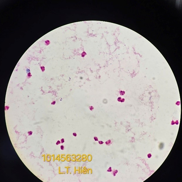 Viêm màng não do não mô cầu diễn biến phức tạp- Ảnh 2.