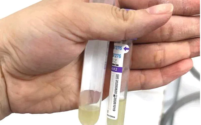 Cảnh giác với viêm màng não do não mô cầu- Ảnh 1.