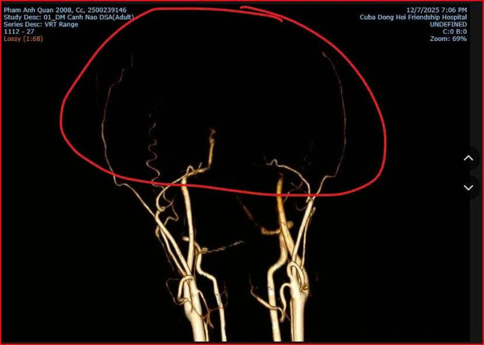 Phân tích y khoa vụ thiếu niên tử vong sau xô xát tại quán bida ở Quảng Trị- Ảnh 1.