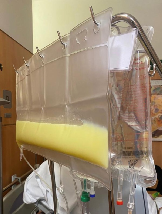 Huyết tương đục như mỡ, người đàn ông nguy kịch vì uống nửa lít rượu mỗi ngày- Ảnh 3.