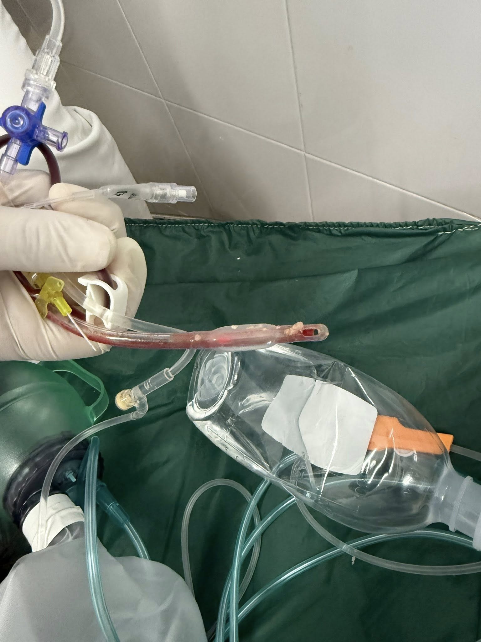 Bác sĩ cấp cứu đau lòng trước bé gái 3 tuổi sặc thức ăn ở nhà trẻ- Ảnh 1. Bác sĩ cấp cứu đau lòng trước bé gái 3 tuổi sặc thức ăn ở nhà trẻ- Ảnh 1.