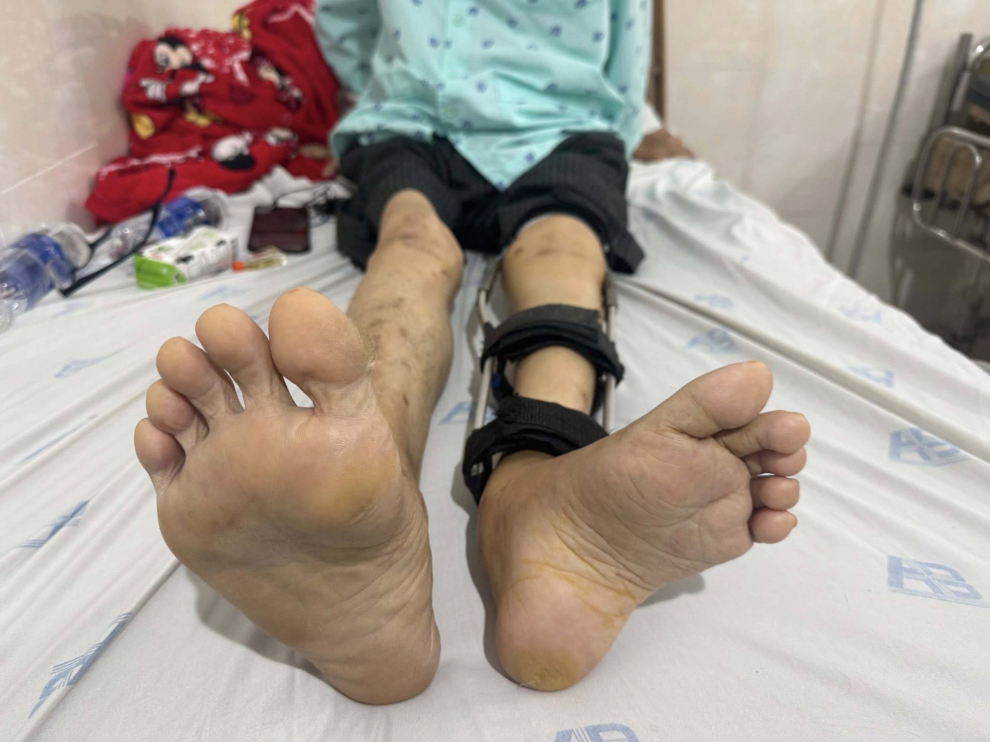 Người đàn ông bị bại liệt hơn 50 năm bỏ được chiếc giày đôn chân 6cm sau ca phẫu thuật- Ảnh 1.
