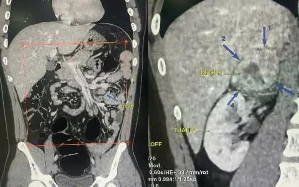 Tiểu hồng kéo dài, nam thanh niên 19 tuổi phát hiện u thượng thận 6 cm- Ảnh 1.