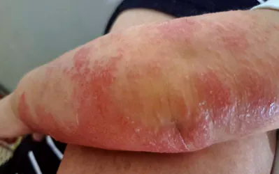 Viêm da cơ địa mùa lạnh: nhận biết sớm và chăm sóc đúng- Ảnh 1.