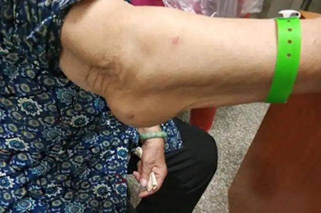 Bất kể nam hay nữ, nếu gặp phải 4 triệu chứng này ở cánh tay, rất có thể bạn bị ung thư: Dấu hiệu thứ 3 bị bỏ qua nhiều nhất- Ảnh 4.