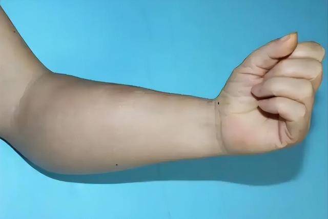 Bất kể nam hay nữ, nếu gặp phải 4 triệu chứng này ở cánh tay, rất có thể bạn bị ung thư: Dấu hiệu thứ 3 bị bỏ qua nhiều nhất- Ảnh 5.