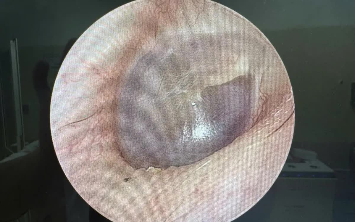 Cholesteatoma bẩm sinh: "Vi&ecirc;n ngọc trai" nguy hiểm sau m&agrave;ng nhĩ- Ảnh 1.