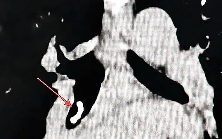 Phát hiện dị vật phế quản hiếm gặp sau hơn 1 tháng điều trị không hiệu quả- Ảnh 1.