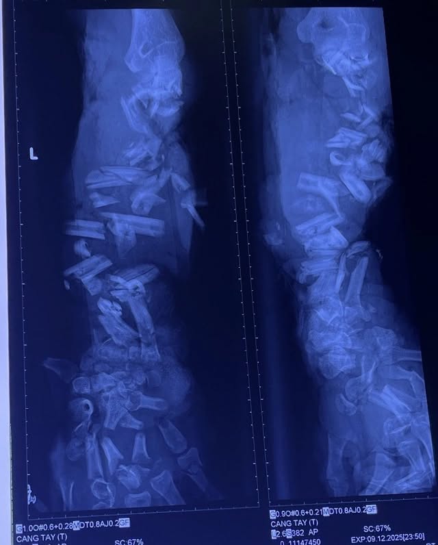 Tai nạn lao động thương tâm: Công nhân 37 tuổi bị máy nghiền vỏ dừa cán nát cánh tay - Ảnh 1.