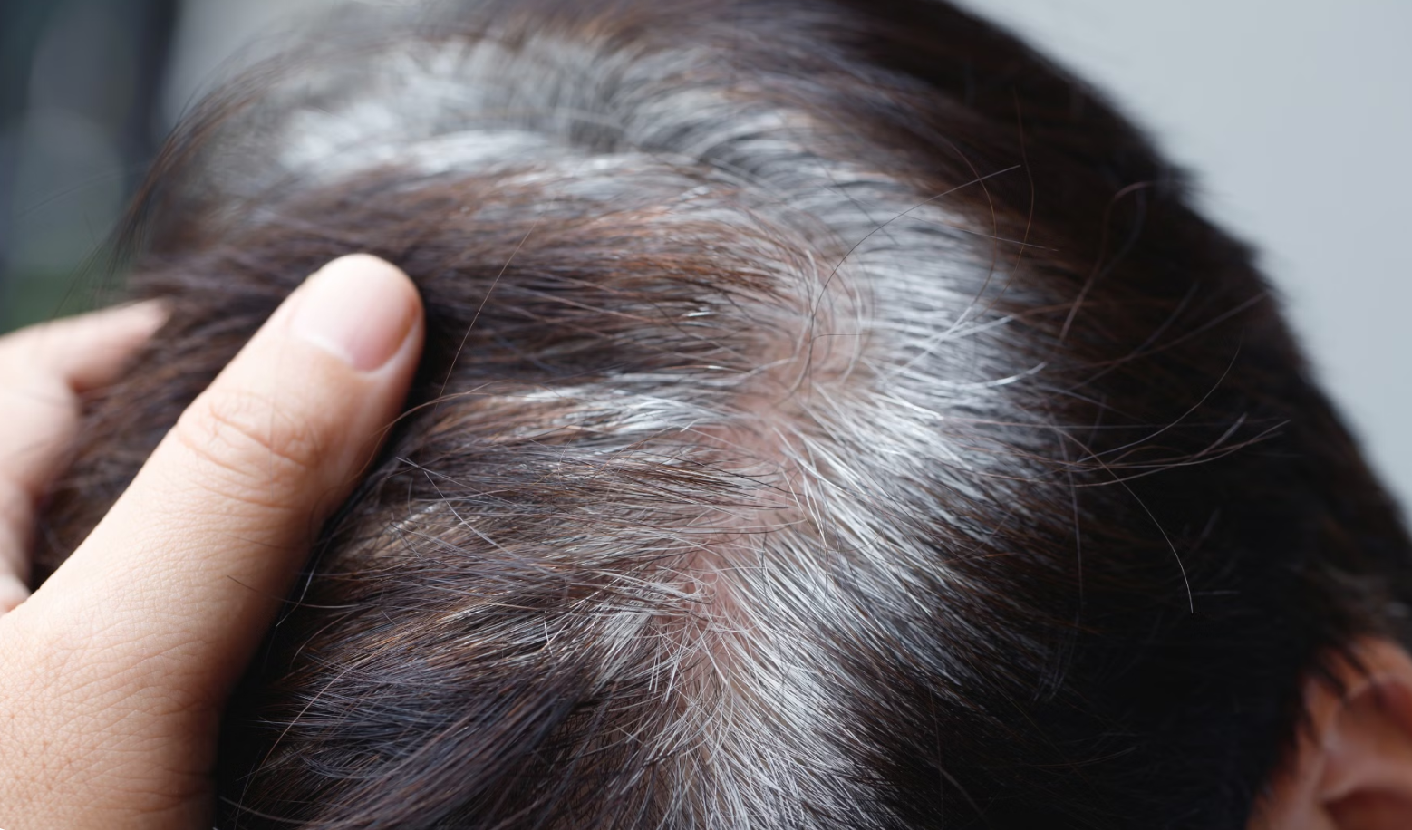 B&aacute;c sĩ n&oacute;i g&igrave; về tin &ldquo;t&oacute;c bạc nhiều l&agrave; dấu hiệu ung thư&rdquo;?