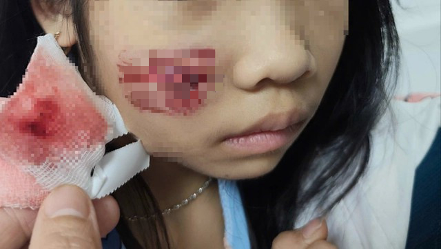 Khỉ hoang tấn công, bé gái 7 tuổi nhập viện- Ảnh 1. Khỉ hoang tấn công, bé gái 7 tuổi nhập viện- Ảnh 1.