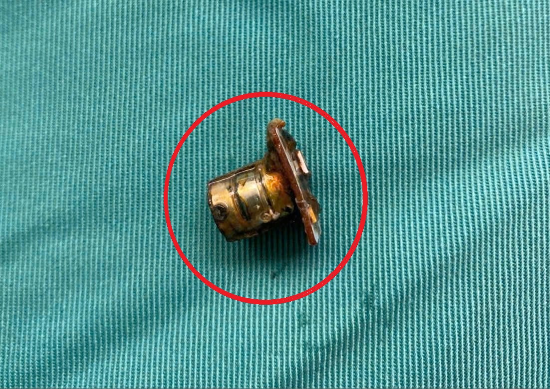 Bé 2 tuổi đang chơi bỗng ho tím tái, bác sĩ gắp ra thứ "đáng sợ" trong bụng- Ảnh 1.