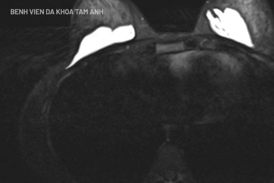 Tháo bỏ chất lạ sau nâng ngực "không xâm lấn"- Ảnh 2. Tháo bỏ chất lạ sau nâng ngực "không xâm lấn"- Ảnh 2.