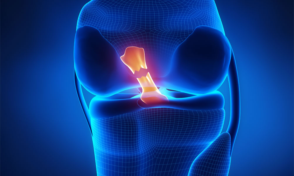 Bác sĩ thừa nhận các chấn thương thường gặp khi chơi pickleball: Cầu lông và tennis cũng không ngoại lệ- Ảnh 3. Bác sĩ thừa nhận các chấn thương thường gặp khi chơi pickleball: Cầu lông và tennis cũng không ngoại lệ- Ảnh 3.