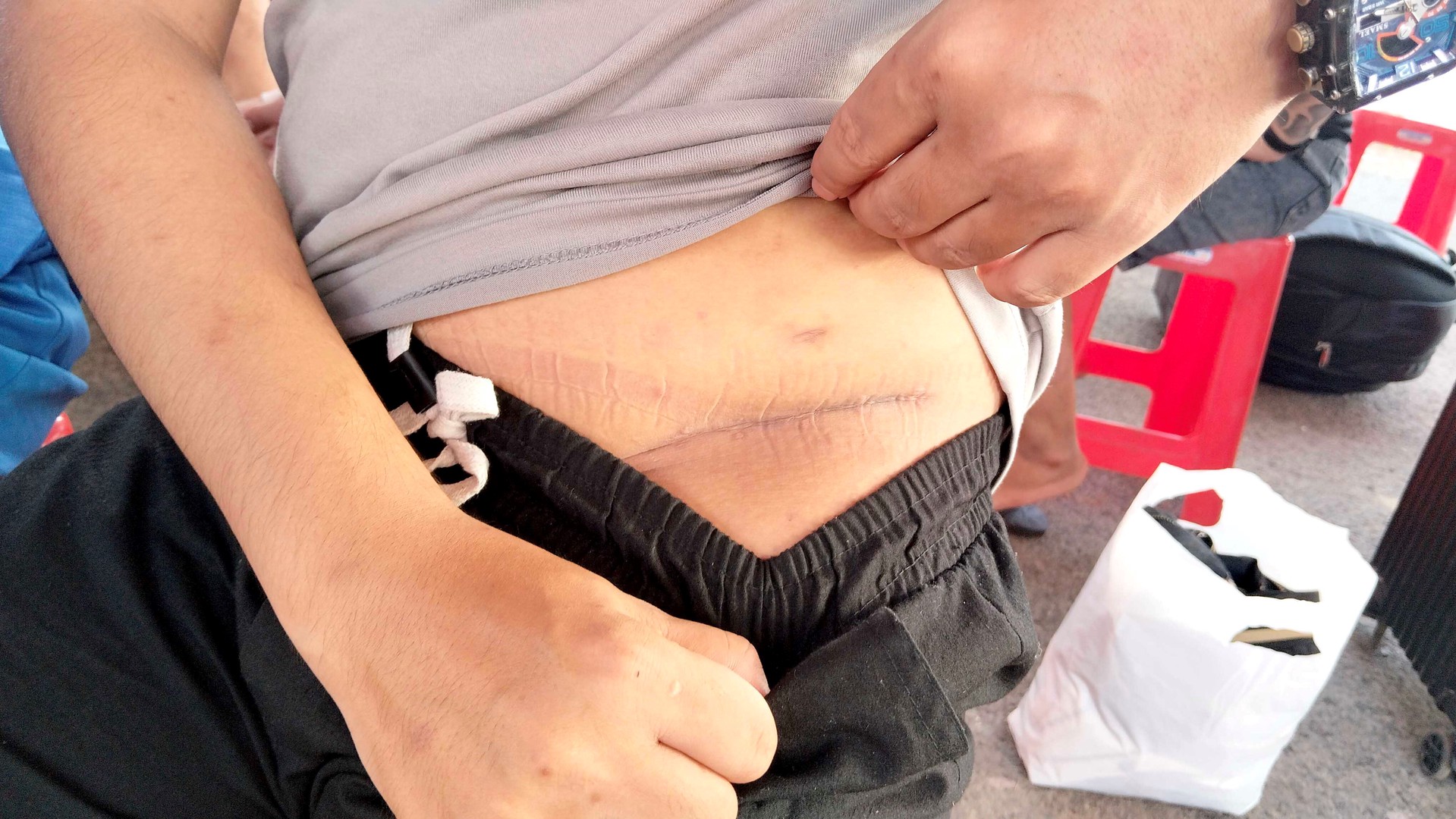 Nam thanh niên sang Campuchia làm “việc nhẹ lương cao” bị cưỡng ép cắt bỏ một quả thận: Vết sẹo dài bên mạn sườn gây ám ảnh- Ảnh 2. Nam thanh niên sang Campuchia làm “việc nhẹ lương cao” bị cưỡng ép cắt bỏ một quả thận: Vết sẹo dài bên mạn sườn gây ám ảnh- Ảnh 2.