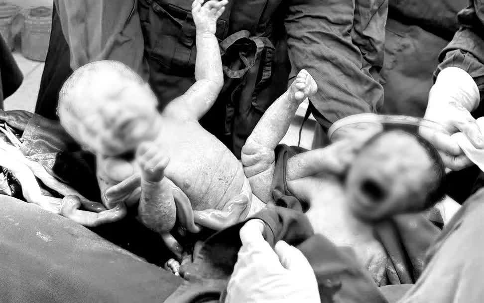 Cứu sản phụ tiền sản giật nặng, bảo toàn song thai IVF- Ảnh 1.