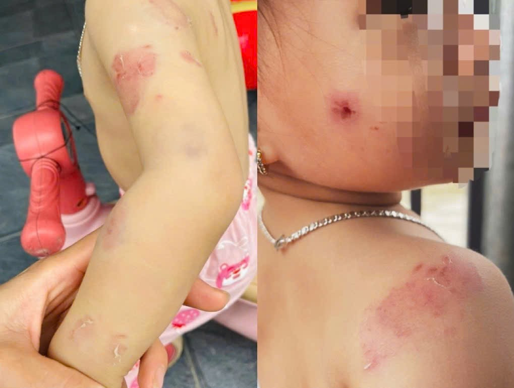 Phụ huynh bức x&uacute;c khi con g&aacute;i hơn 2 tuổi chi ch&iacute;t vết cắn tr&ecirc;n người sau giờ học- Ảnh 1.