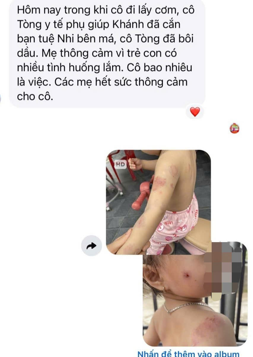 Phụ huynh bức x&uacute;c khi con g&aacute;i hơn 2 tuổi chi ch&iacute;t vết cắn tr&ecirc;n người sau giờ học- Ảnh 2.