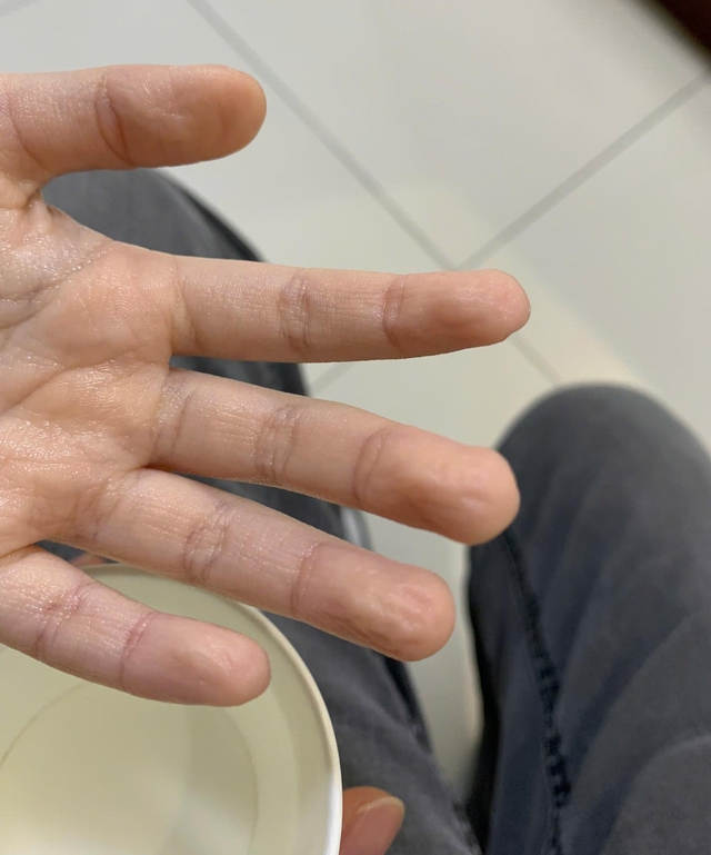 B&eacute; g&aacute;i được bố đưa đến kh&aacute;m v&igrave; ho hơn 2 năm kh&ocirc;ng dứt, b&aacute;c sĩ y&ecirc;u cầu b&eacute; nh&uacute;ng tay v&agrave;o nước v&agrave; kết quả vỡ &ograve;a- Ảnh 2.