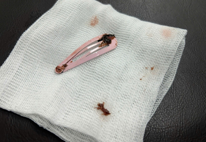 Gắp kẹp t&oacute;c d&agrave;i 7cm khỏi dạ d&agrave;y b&eacute; g&aacute;i 6 tuổi- Ảnh 1.