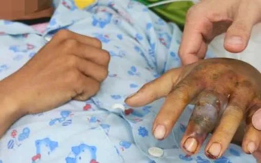 Rắn cắn nguy hiểm: Kh&ocirc;ng đắp l&aacute;, kh&ocirc;ng chữa mẹo- Ảnh 1.