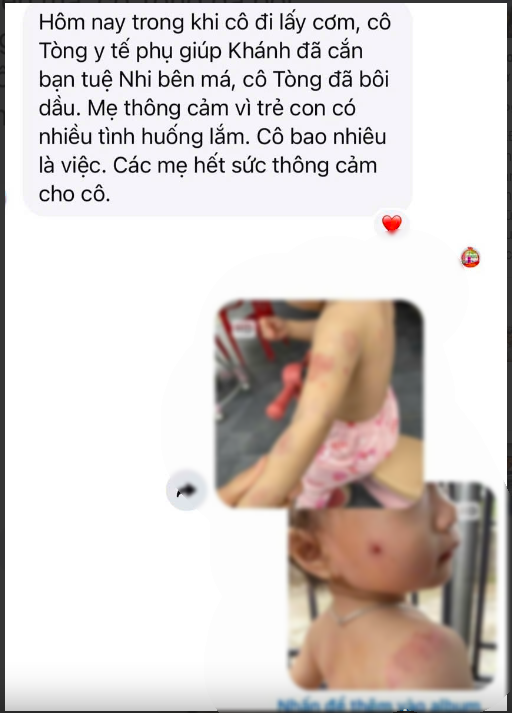 Bé hơn 2 tuổi có nhiều vết cắn, bầm tím: Giáo viên nói "quá nhiều việc", nhà trường báo "camera mất dữ liệu"- Ảnh 1. Bé hơn 2 tuổi có nhiều vết cắn, bầm tím: Giáo viên nói "quá nhiều việc", nhà trường báo "camera mất dữ liệu"- Ảnh 1.