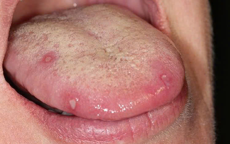 5 điều lưỡi c&oacute; thể tiết lộ về sức khỏe: Từ ung thư đến nguy cơ đột quỵ cũng hiện ra!- Ảnh 1.