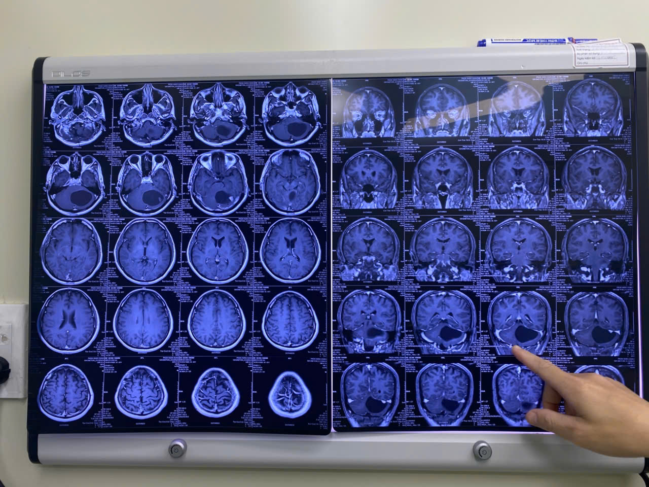 150 ph&uacute;t nghẹt thở với người đ&agrave;n &ocirc;ng v&agrave;o bệnh viện trong t&igrave;nh trạng đau đầu dữ dội- Ảnh 1.