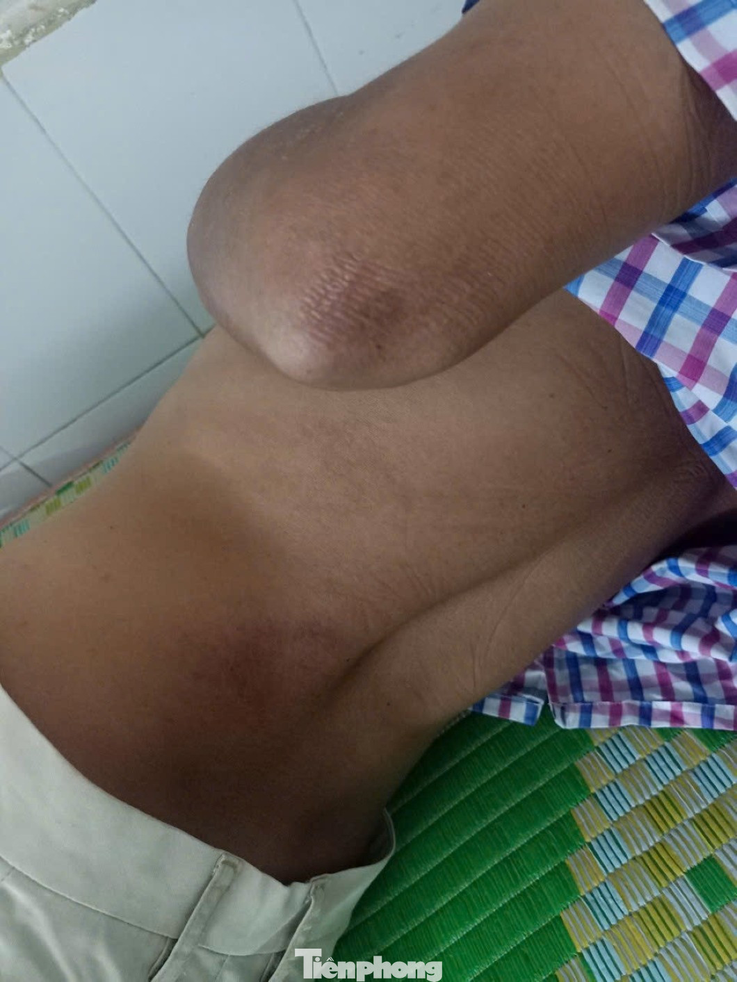 Vụ bị đ&aacute;nh đến &lsquo;th&acirc;n t&agrave;n ma dại&rsquo;, thương t&iacute;ch 0%': Dấu hỏi nguy&ecirc;n nh&acirc;n khiến nạn nh&acirc;n yếu liệt tứ chi?- Ảnh 2.