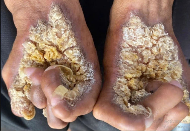 Da x&ugrave; x&igrave; như mọc nấm v&igrave; hội chứng lạ- Ảnh 1.