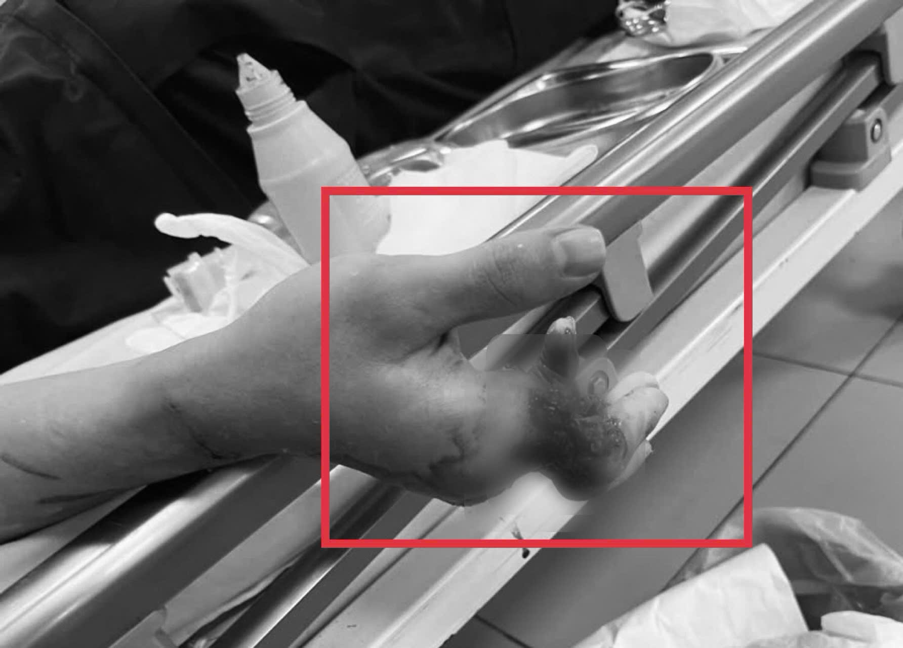 Cuộc mổ xuyên đêm cứu 4 ngón tay dập nát, gần đứt rời- Ảnh 1. Cuộc mổ xuyên đêm cứu 4 ngón tay dập nát, gần đứt rời- Ảnh 1.