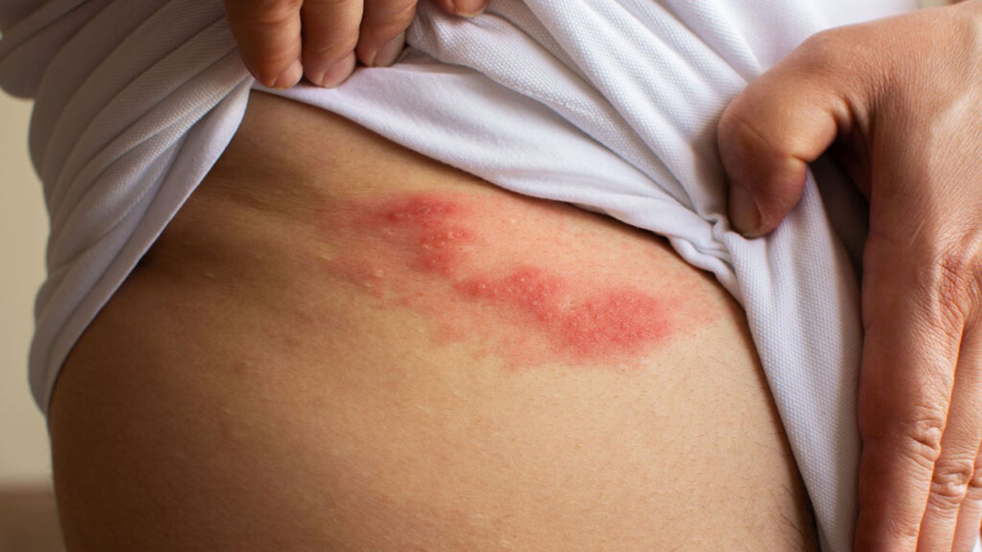 Đáng sợ cơn đau dai dẳng sau khỏi bệnh “giời leo”- Ảnh 1. Đáng sợ cơn đau dai dẳng sau khỏi bệnh “giời leo”- Ảnh 1.