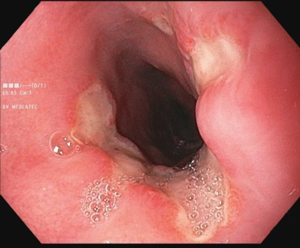 B&aacute;c sĩ bất ngờ khi thấy thực quản bệnh nh&acirc;n lo&eacute;t nặng: 'Thủ phạm' l&agrave; sai lầm nhiều người Việt mắc- Ảnh 1.