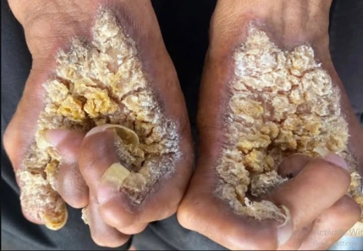 Người đ&agrave;n &ocirc;ng thứ hai tại Việt Nam mắc hội chứng &ldquo;người c&acirc;y&rdquo;- Ảnh 1.