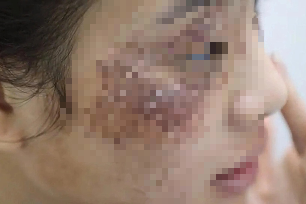 Cô gái bị tàn phá dung nhan vì bôi kem mua trên mạng- Ảnh 1.