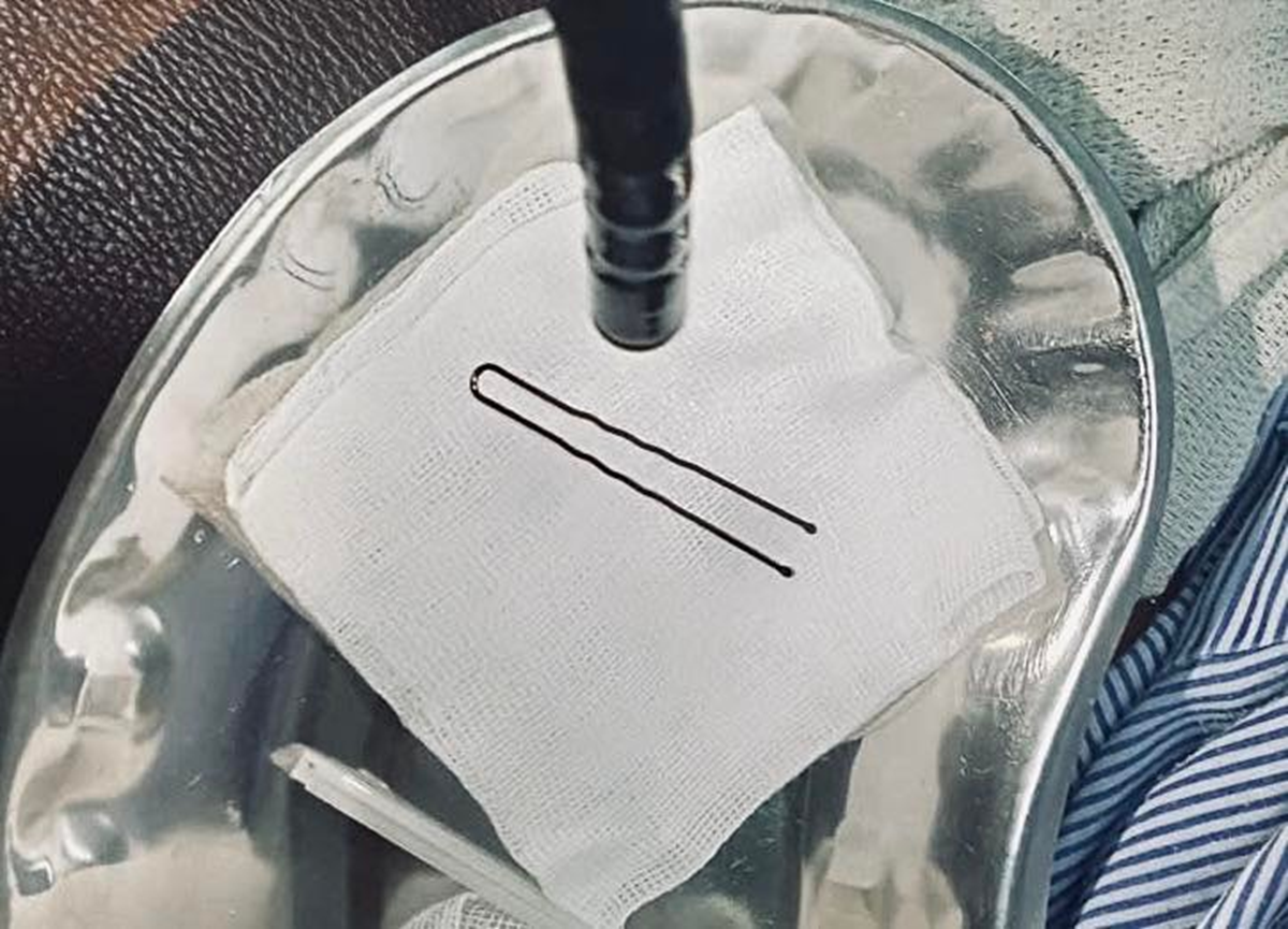 Bé gái 4 tuổi đột ngột khóc thét, vào viện bác sĩ gắp ra thứ "đáng sợ" bên trong- Ảnh 1.