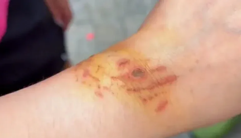 Kinh hoàng cảnh cô gái bị cá mập cắn nhưng vẫn từ chối lên bờ vì muốn chụp thêm ảnh- Ảnh 3.