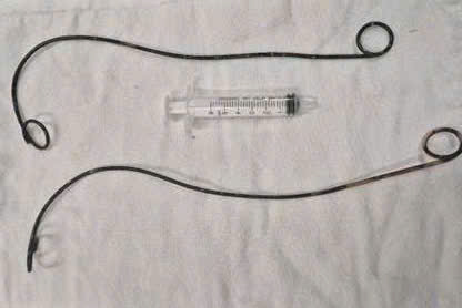 Bệnh nhân ở Cà Mau "bỏ quên" ống thông JJ trong người suốt hơn 10 năm- Ảnh 1. Bệnh nhân ở Cà Mau "bỏ quên" ống thông JJ trong người suốt hơn 10 năm- Ảnh 1.