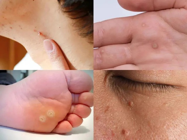 C&ocirc; g&aacute;i 19 tuổi nhiễm c&ugrave;ng l&uacute;c 8 chủng HPV: Khi sự chủ quan của tuổi trẻ c&oacute; thể phải trả gi&aacute; bằng sức khỏe sinh sản- Ảnh 3.