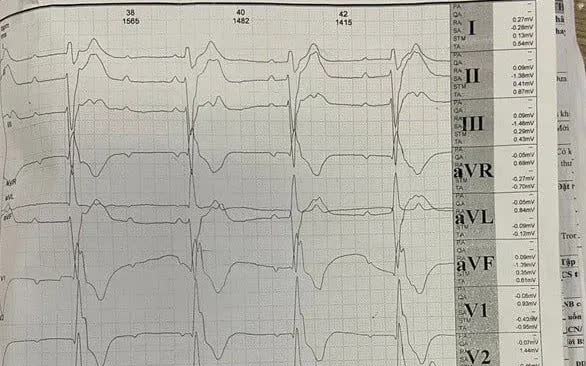 Hội chứng Kearns-Sayre - bệnh di truyền hiếm đe dọa tim mạch ở người trẻ- Ảnh 1.
