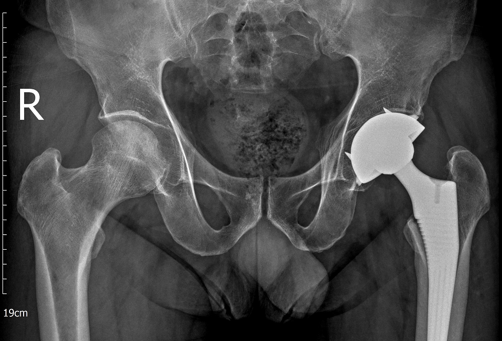 Bệnh nh&acirc;n nghiện thuốc l&aacute; b&agrave;ng ho&agrave;ng khi b&aacute;c sĩ th&ocirc;ng b&aacute;o bị&hellip; hoại tử xương- Ảnh 2.