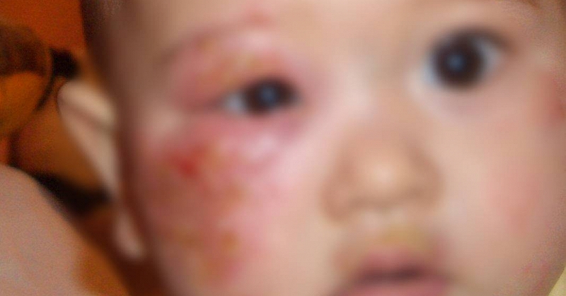 B&eacute; g&aacute;i 4 tuổi mắc giang mai - nguồn l&acirc;y kh&ocirc;ng ngờ từ một th&oacute;i quen cho ch&aacute;u ăn của b&agrave; nội