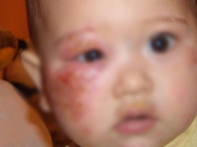 B&eacute; g&aacute;i 4 tuổi mắc giang mai - nguồn l&acirc;y kh&ocirc;ng ngờ từ một th&oacute;i quen cho ch&aacute;u ăn của b&agrave; nội- Ảnh 2.