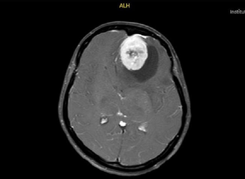Người phụ nữ bị u m&agrave;ng n&atilde;o khổng lồ, b&aacute;c sĩ chỉ ra những dấu hiệu dễ nhầm lẫn- Ảnh 1.