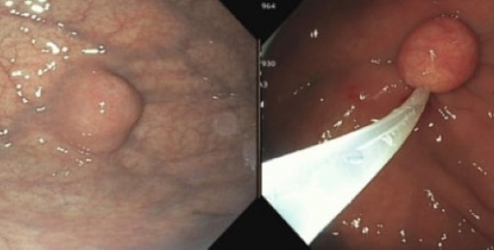 Ph&aacute;t hiện khối u dạ d&agrave;y 1,4 cm khi đi kh&aacute;m sức khỏe định kỳ- Ảnh 1.